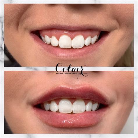 botox    smile lines