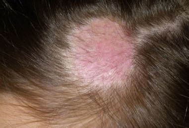 HOW TO GET RID OF RINGWORM ON THE SCALP - get rid of ringworm