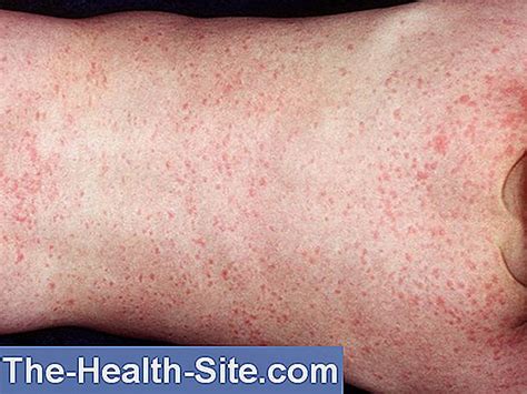 Roseola 💊 Scientific-Practical Medical Journal - 2024