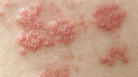 long   shingles rash  sharecare