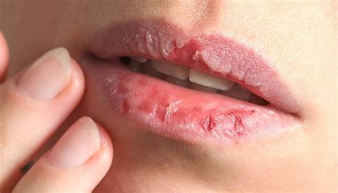 What it is and how to get out of dermatillomania | Emergency Live