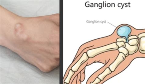 Ganglion Cysts and Physiotherapy