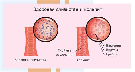 Гинекологическое заболевание кольпит - причины воспаления, симптомы ...