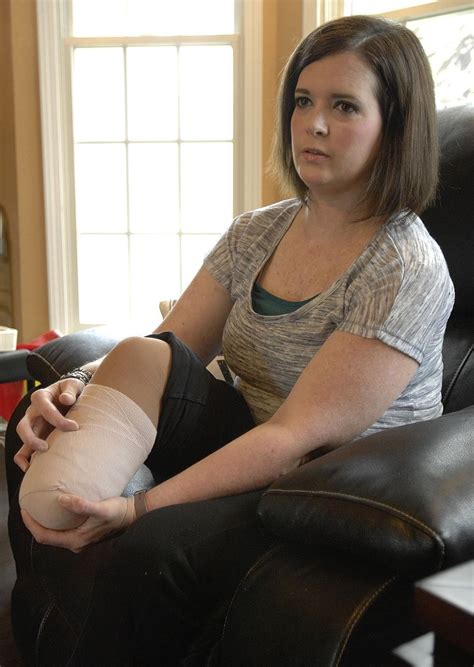 Train Arm Amputation