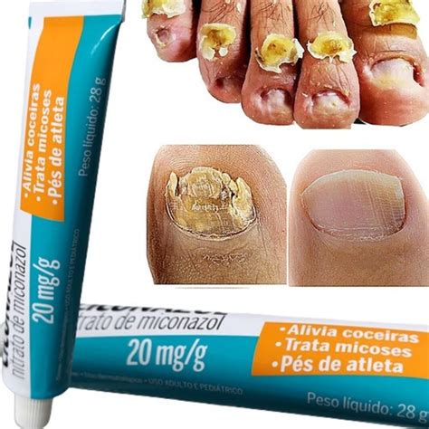 Qual A Melhor Pomada Para Unha Inflamada - Pomada Creme P/ Tratamento De Unhas Com Fungos E Micose | Parcelamento ...
