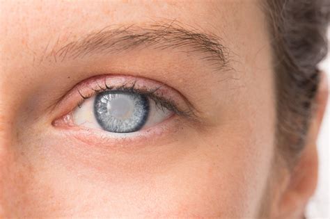 Cataracts, Diagnosis of Cataracts, Treatment of Cataracts, and 3 ...