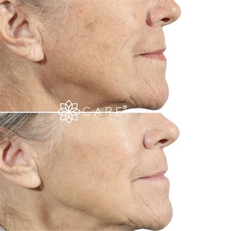 Bio-LIFT - CARE Esthetics