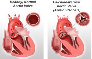 Normal Aortic Valve