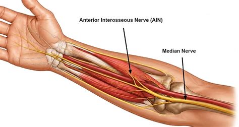 Forearm Splints - Symptoms, Causes and Treatment