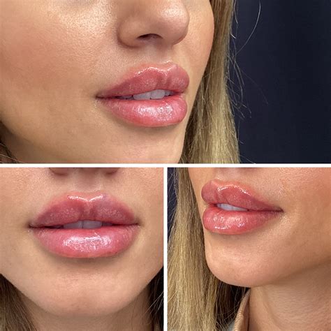 Lip Filler in Vienna Virginia - Milani MedSpa
