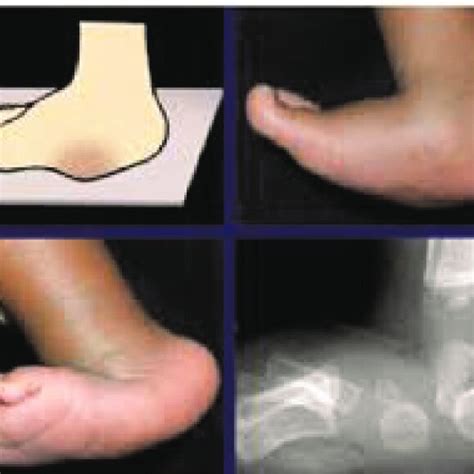 congenital vertical talus  scientific diagram
