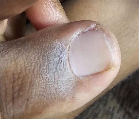 Does this look like the nail may have to be removed? : r/Ingrown_Toenails