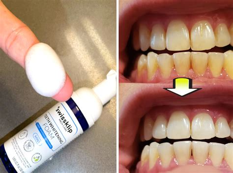 Top 10 Products for Teeth Whitening