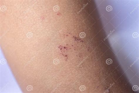 Atopic Dermatitis and Fungal Diseases on the Human Body. Editorial ...