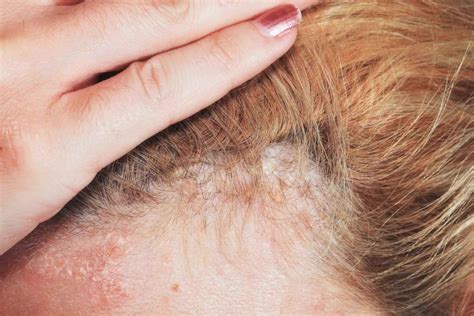 Guide To Scalp Psoriasis: Know Their Symptoms, Treatments, And Prevention