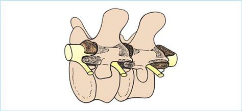 epidural anesthesia anesthesia key