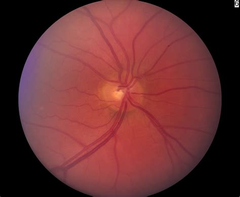 Ch. 1 Glaucoma: Optic Nerve Disease. A Patient's Guide to Glaucoma