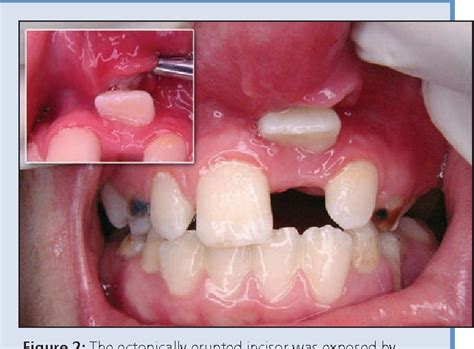 Figure 5 from Unusual ectopic eruption of a permanent central incisor ...