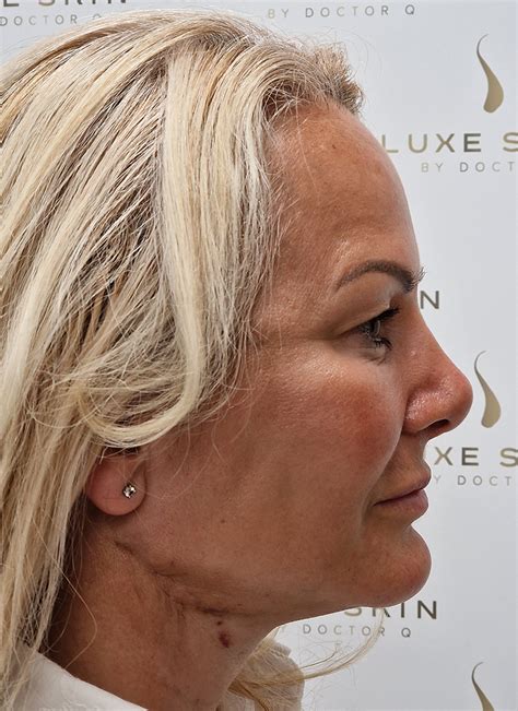 lift  glasgow  surgical face  neck lift