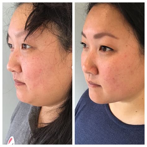 kybella arm fat     billy newby blog