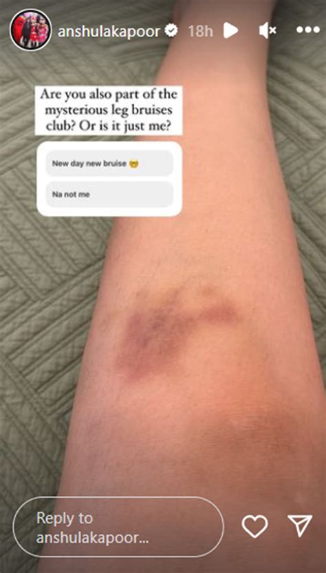Have you ever noticed ‘mysterious’ bruises on your legs, arms and other