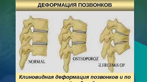 Остеопороз. Профилактика остеопороза - презентация онлайн