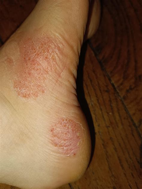 Red scaly peeling skin : r/DermatologyQuestions