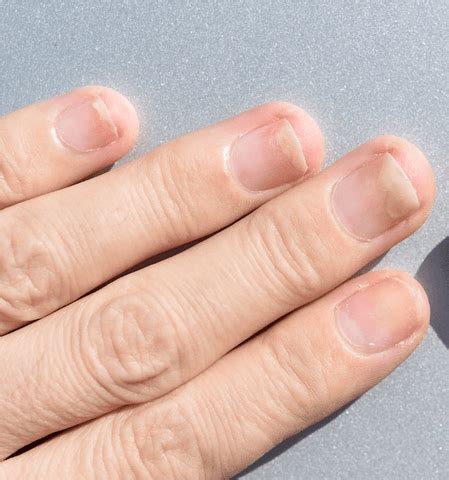 Onycholysis of the nails - what is it, what are the causes, and how to