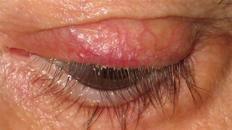 Blefaritis | Oftalmología Avanzada