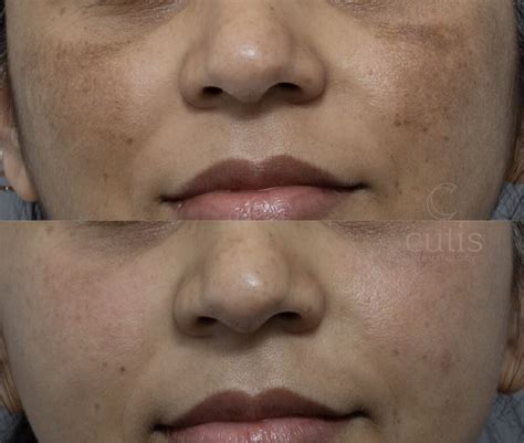 Best Melasma Treatment Packages Brisbane Cutis Dermatology