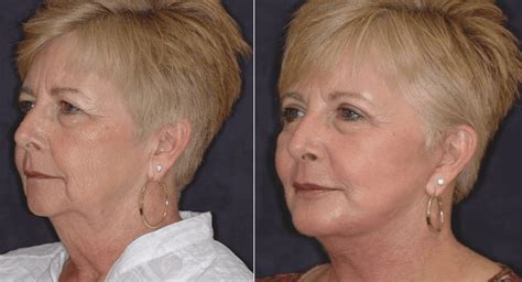 Facelift Indianapolis | Rhytidectomy | Face Lift Surgery | Facelift Surgeon