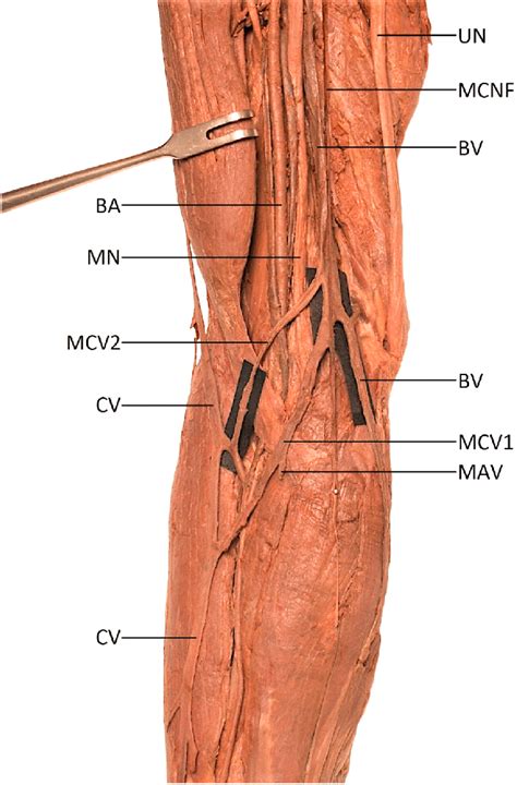 Duplication of the median cubital vein. Wet specimen of the isolated ...