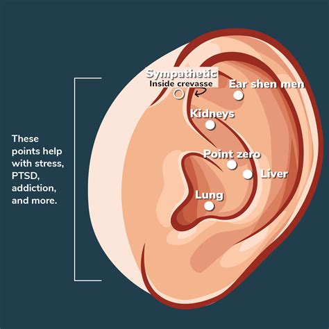 Acupuncture Ear Seed Demo | NADA Protocol - Aligned Modern Health