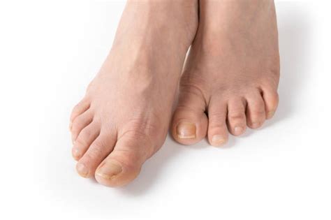 Dorsum Of The Foot Pic Stock Photos, Pictures & Royalty-Free Images ...