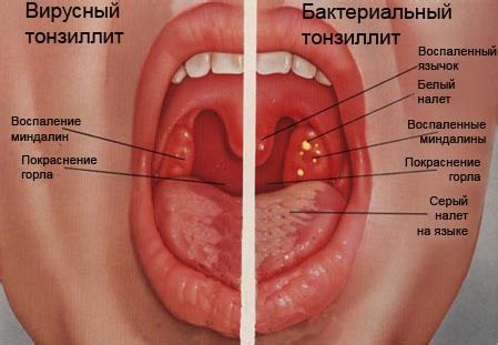 Ангина. Симптомы. Лечение - Клиника Здоровье 365 г. Екатеринбург