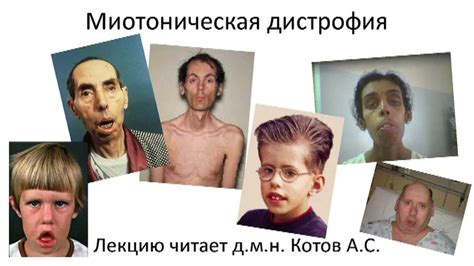 Миотоническая дистрофия - YouTube