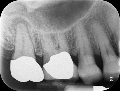 Maxillary Sinusitis of Endodontic Origin (MSEO) - Seattle Endodontics