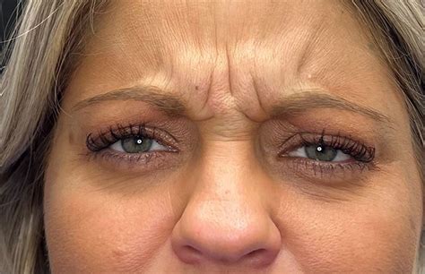 frown lines medical spa  arlington colleyville