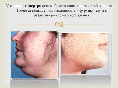 Синдром Иценко - Кушинга - презентация онлайн