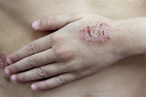 Dermatite: o que é, sintomas, tipos, causas e tratamento (com fotos ...