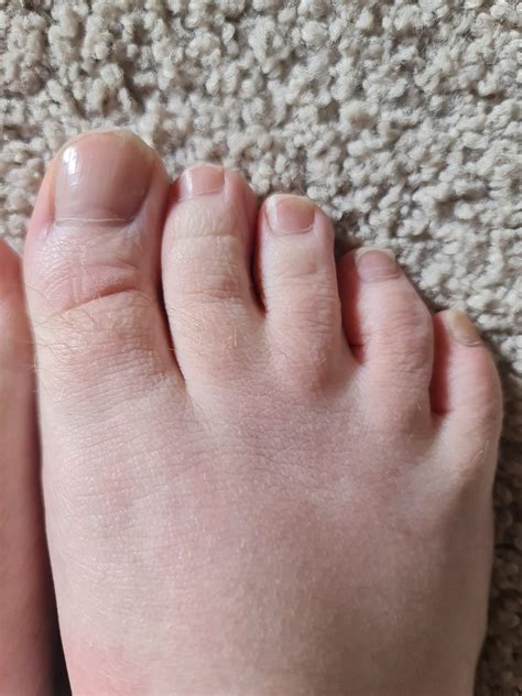 Introduction to my webbed toes and feet. Left foot is more webbed then ...