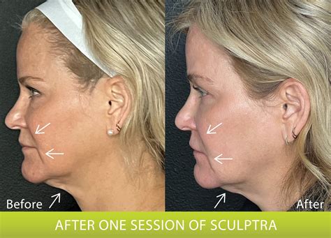 full face sculptra before and after 6