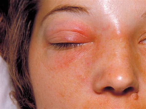 periorbital cellulitis contagious