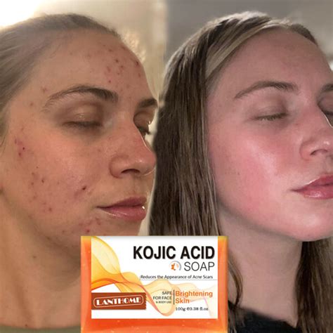 Kojic Acid Soap Before and After: Does It Really Lighten Skin? - Must ...