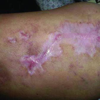 Pyoderma gangrenosum. Large purulent ulcer with violaceous undermined