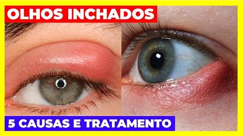 Inchaço E Dor Nos Olhos