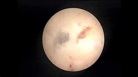 Vaginoscopy - YouTube