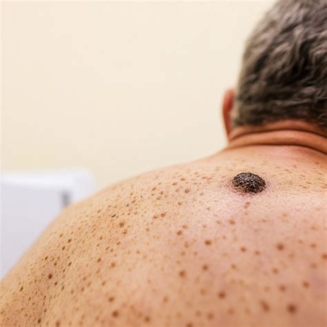 nevus seborrheic keratosis