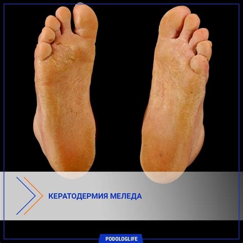 КЕРАТОДЕРМИЯ МЕЛЕДА (синонимы: кератодермия ладонно-подошвенная ...