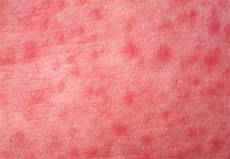 Celiac Disease - Pictures, Rash, Signs, Causes, Treatment